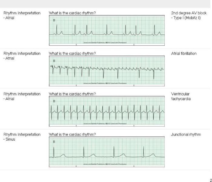 Relias dysrhythmia basic b 35 questions