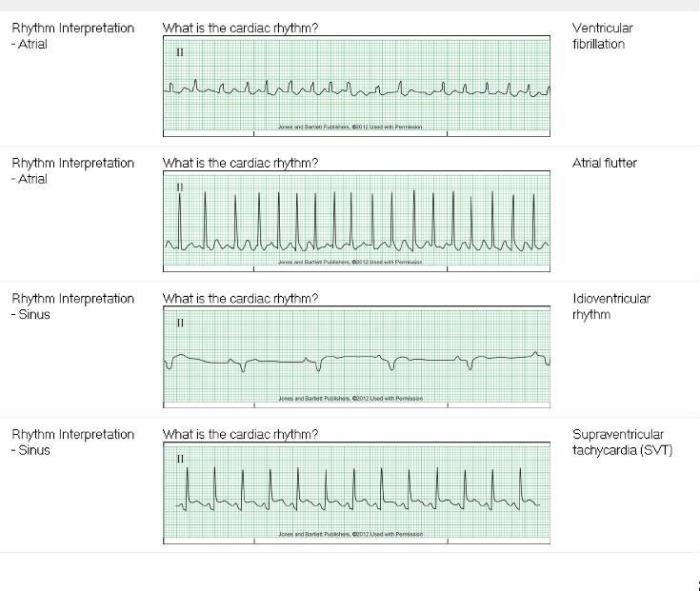 Relias dysrhythmia basic b 35 questions