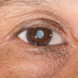 Cataract cataracts eye surgery vision shutterstock needed when lens lenses laser clouding quality high disease woolfson institute comes